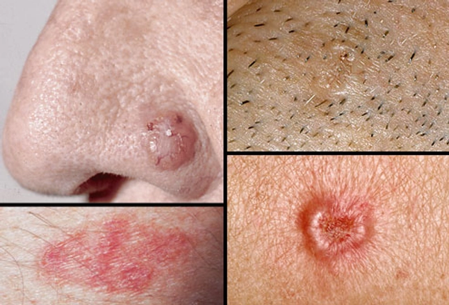 Picture Of Basal Cell Carcinoma