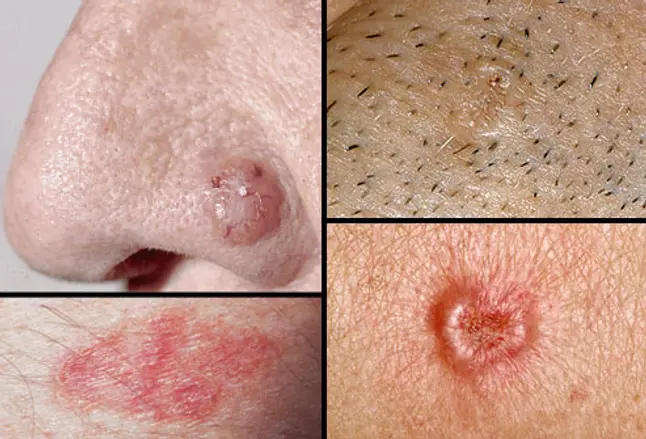 Collage of basal cell carcinoma