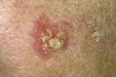 Skin Cancer Photos What Skin Cancer Precancerous Lesions Look Like