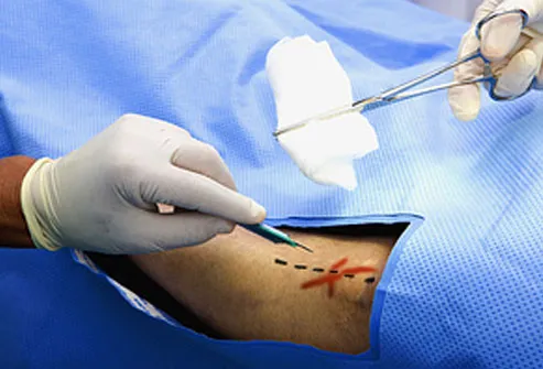 Surgical marking