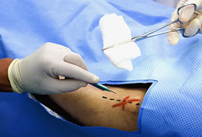 X Marks the Surgical Spot