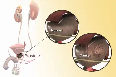 prostata tumor