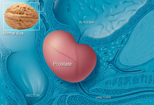 Enlarged Prostate or Prostate Cancer?
