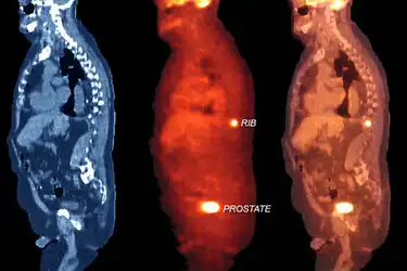 Spots a prosztatitis Mycoplasma és prostatitis