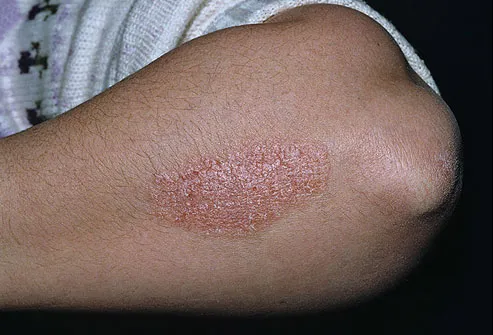 Image result for psoriasis