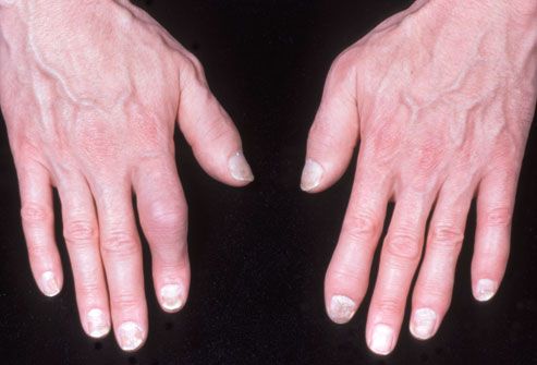 plaque psoriasis hands pictures