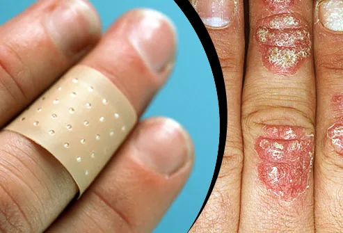 Finger in plastic bandage/Psoriasis on fingers