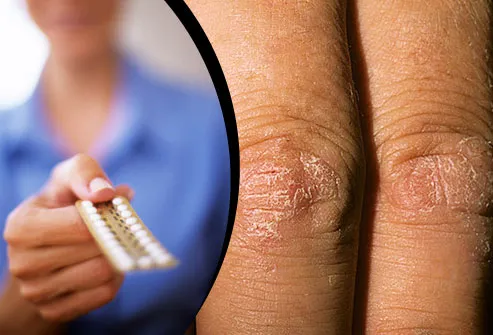 Birth control pills/Psoriasis on knuckles