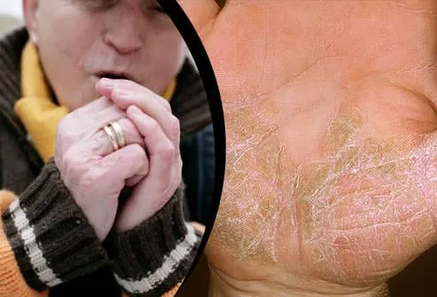 Shivering man outside/Psoriasis on palm of hand