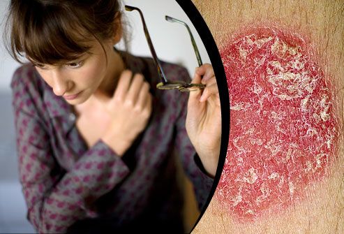 is psoriasis caused by stress)