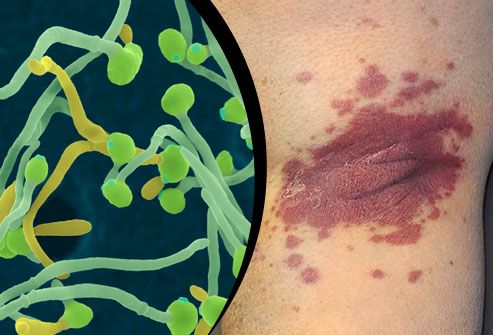 what triggers psoriasis outbreaks