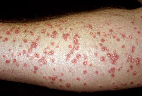 guttate psoriasis severe itching