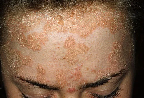 does psoriasis burn on face)