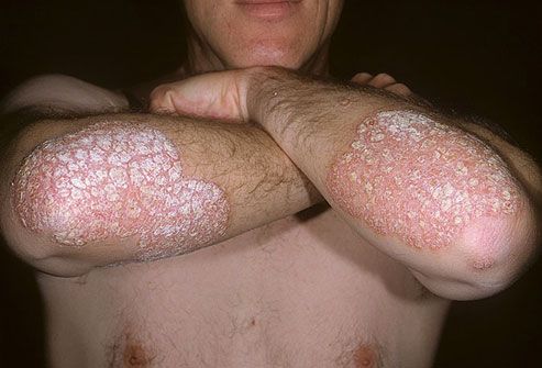 photo of psoriasis on arms