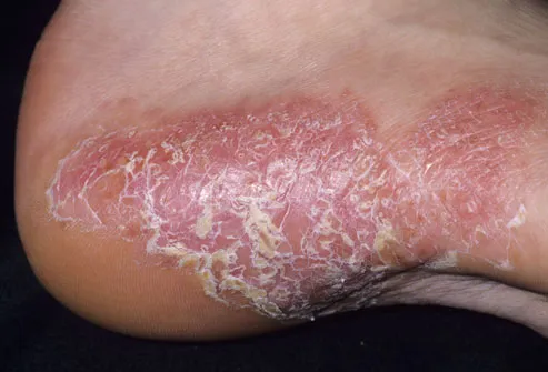 psoriasis pustular feet