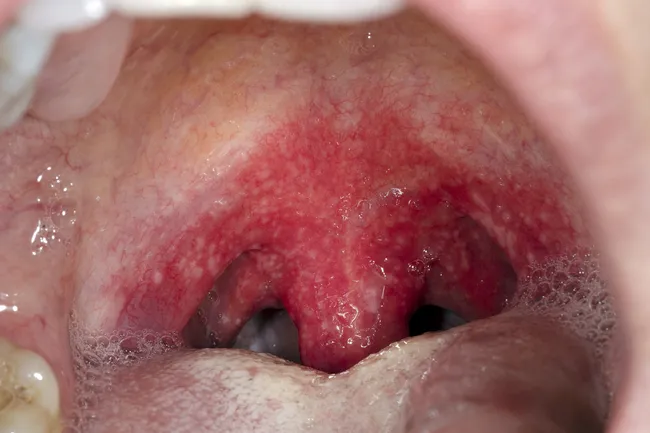 photo of strep throat