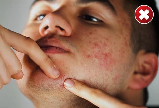 DON'T: Squeeze Your Pimples