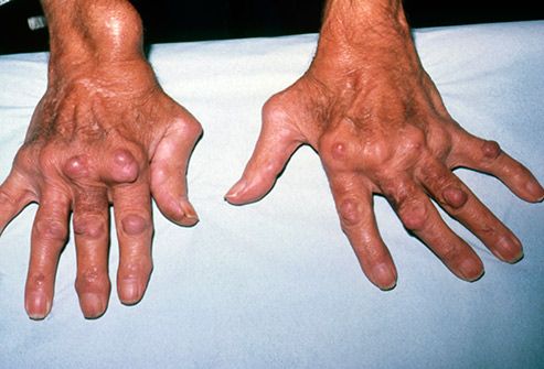 autoimmune disorder rheumatoid arthritis