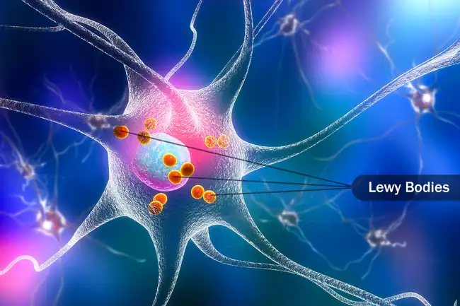 lewy bodies in brain cell illustration