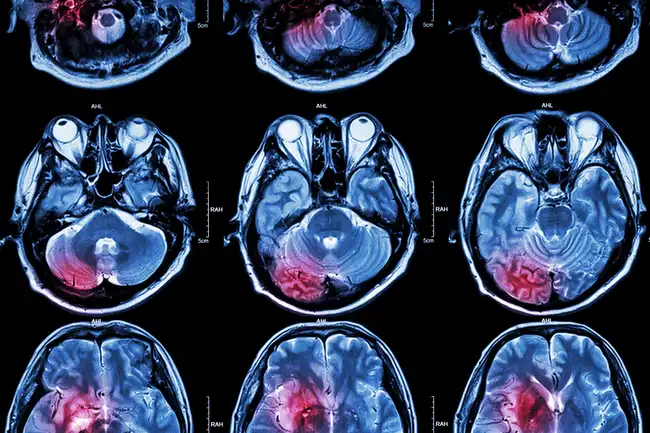 stroke shown in brain scan