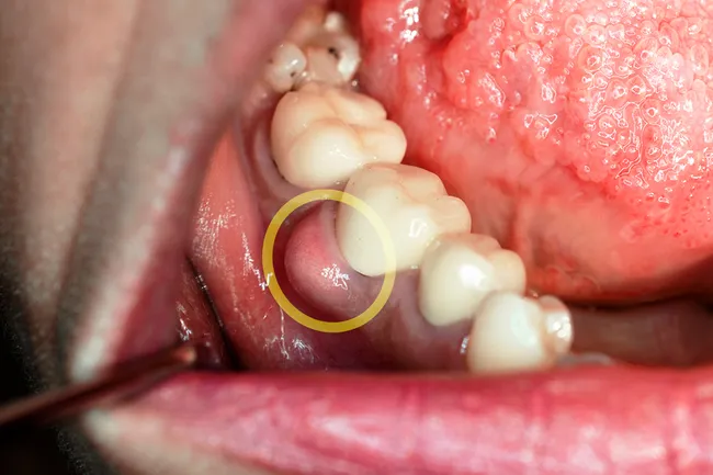 photo of abscessed tooth