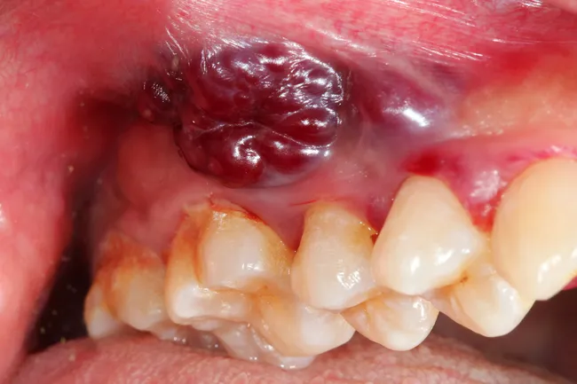 photo of oral cancer on gumline