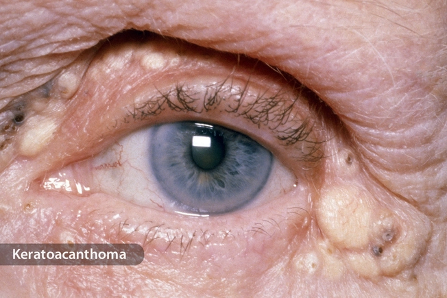 Eyelid Tumor