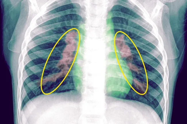 pneumonia lung xray
