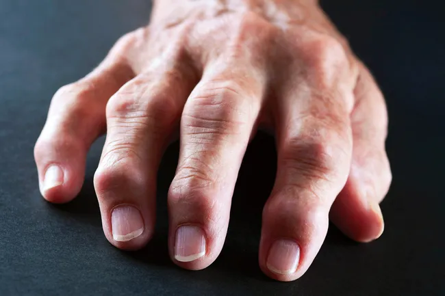 hand displaying rheumatoid arthritis