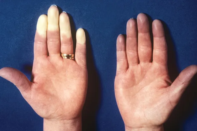 raynauds syndrome