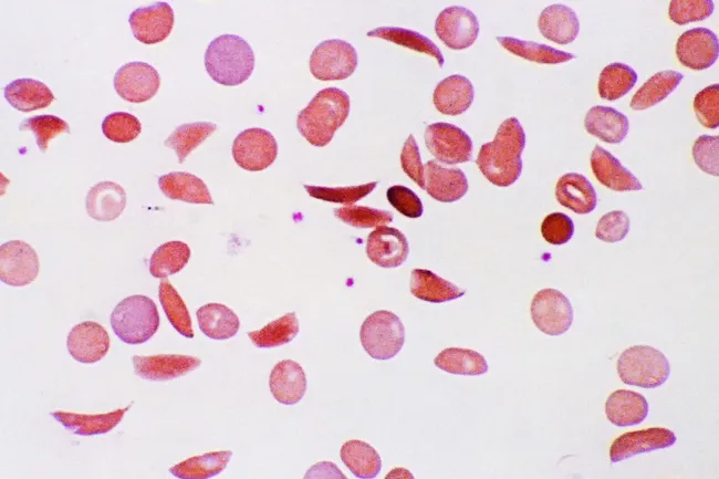 sickle cell anemia micrograph