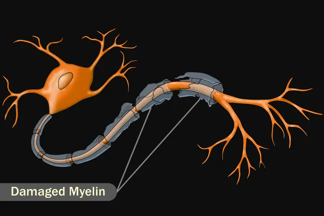 illustration of damaged myelin