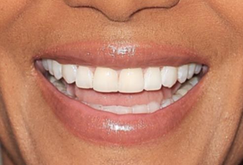Halle Berry's Smile