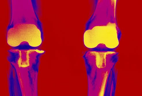 Colored X-ray showing replacement  of knee joints