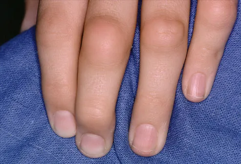 Rheumatoid nodules on the fingers