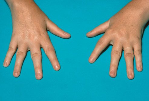 child's hands with juvenile rheumatoid arthritis