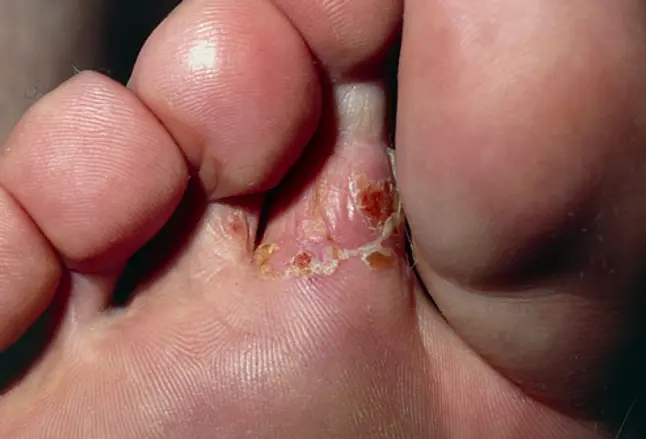 Close-up of athlete's foot (tinea pedis) infection
