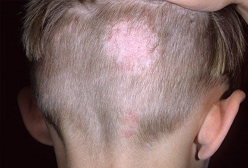 scalp conditions