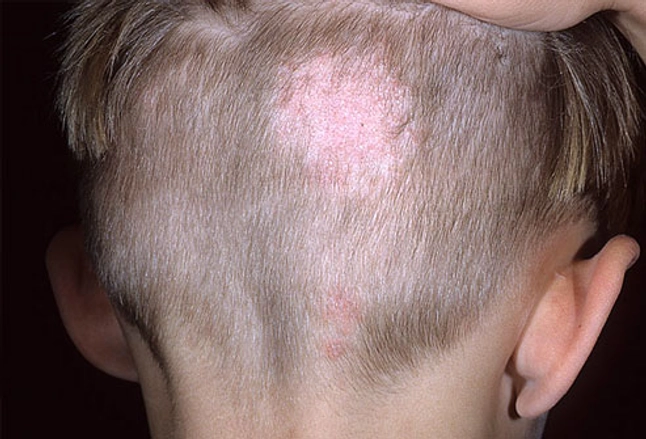 Picture Of Ringworm Of The Scalp Tinea Capitis