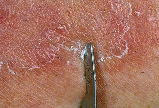 Physician scraping sample of ringworm