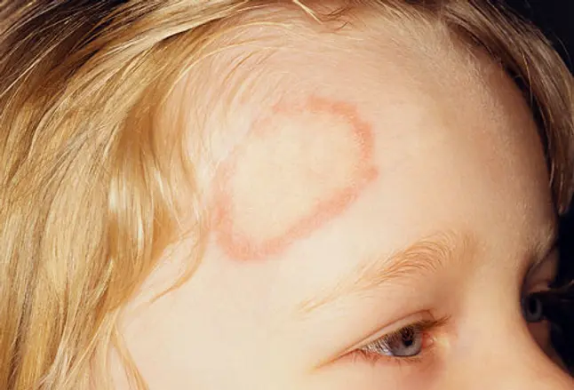 Close-up of ringworm on the forehead of a child