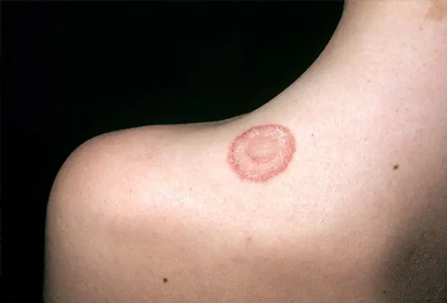 Ringworm (tinea corporis) rash on the shoulder