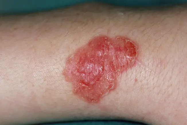 Scabies Complications