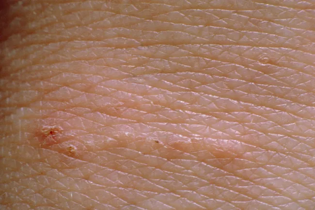 Scabies Pictures Of Rash Mites Symptoms Treatment