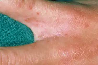 Warts Pictures Causes Types Removal And Treatment