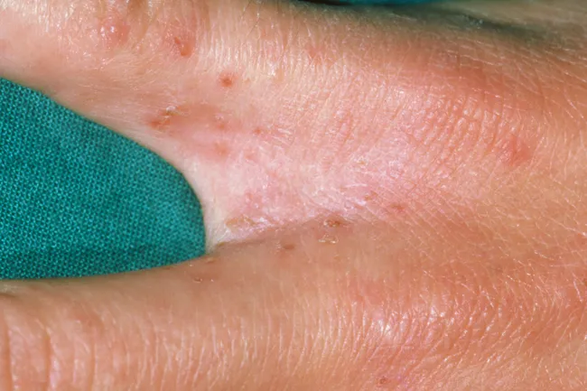 Scabies On Face