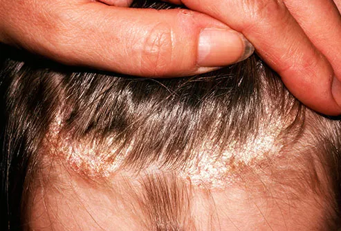 scalp psoriasis symptoms and signs