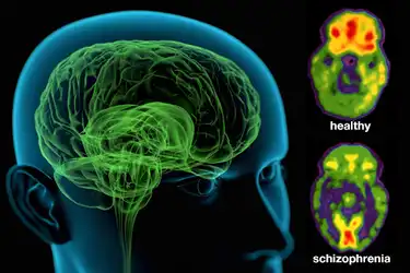 Schizophrenia How Schizophrenia Affects Thoughts Behavior And More