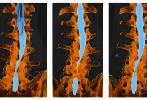 princ rm photo of ct scan of spine