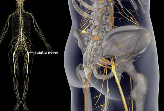 What Is Sciatica?